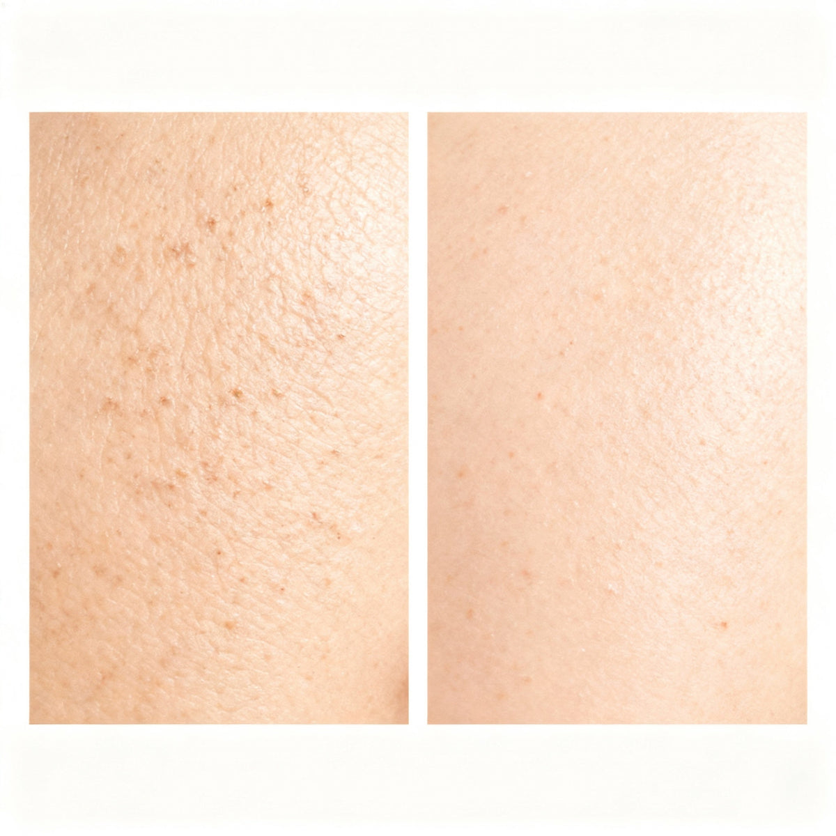 Before-and-after skin comparison using the NovaPeel Ultrasonic Skin Scrubber